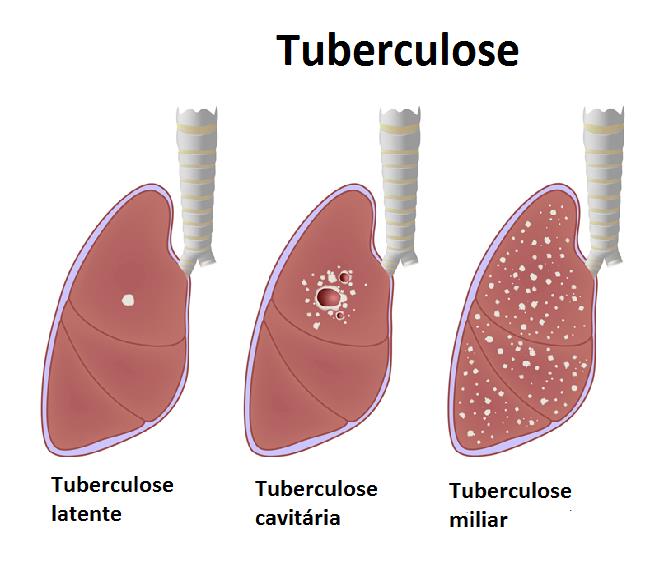 Tipos de Tuberculose